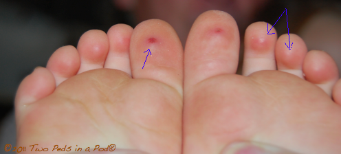 Red painful spots on toes | Skin Growths and Pigment ...