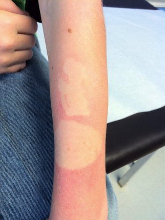 Don't be rash: tidbits about Lyme disease, poison ivy, and sunburn  protection - Two Peds in a Pod®