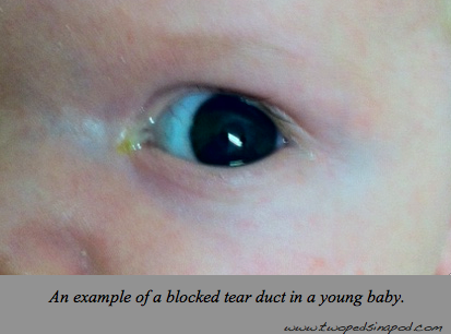 Newborn Eyes Blocked Tear Ducts Crossed Eyes Vision And Eye Color Two Peds In A Pod