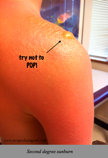 Sunburn and Sunscreens: your burning questions answered - Two Peds in a Pod®