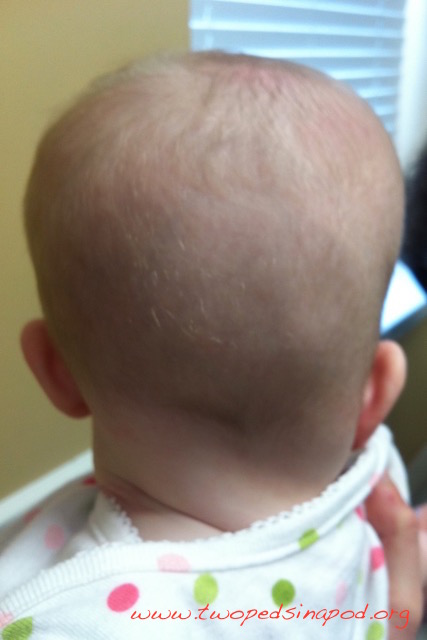 Why is my baby’s head flat? About plagiocephaly. – Two Peds in a Pod®