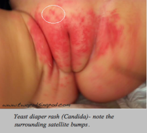 yeast diaper rash